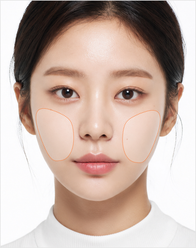 힐로웨이브 시술 부위