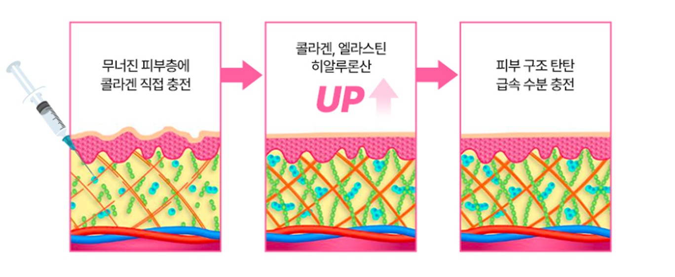 무너진 피부층에 콜라겐 직접 충전 → 콜라겐·엘라스틴·히알루론산 UP → 피부 구조 탄탄, 급속 수분 충전 과정 이미지