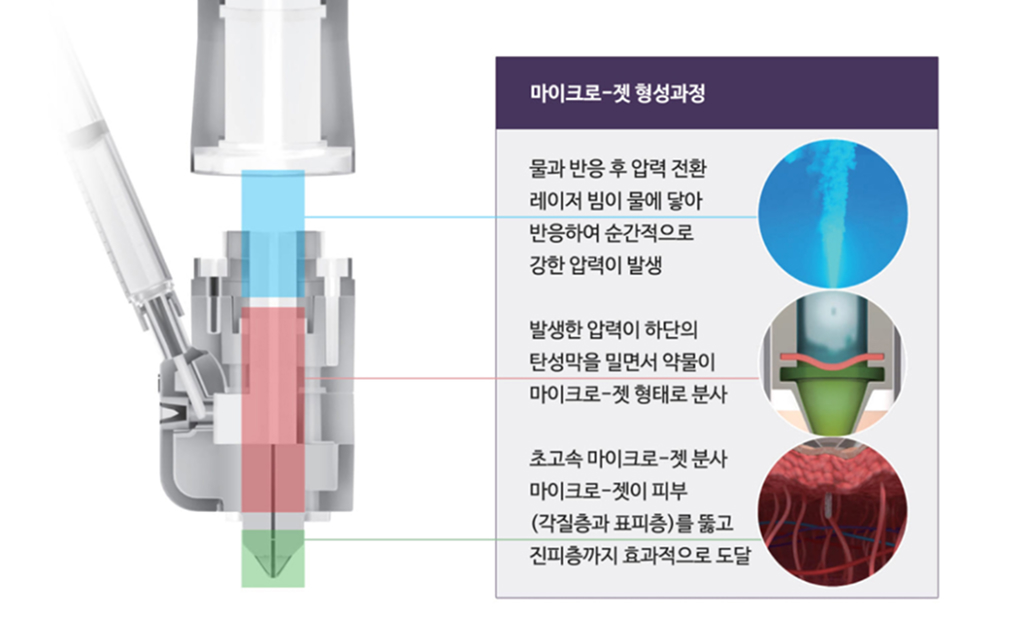 마이크로-젯 형성과정 — 레이저 빔이 물과 반응해 압력 발생, 탄성막을 밀어 약물이 마이크로-젯으로 분사, 초고속 제트가 각질층·표피층을 뚫고 진피층까지 도달