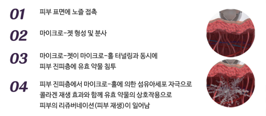 미라젯 시술 과정 4단계 — 01 피부 표면에 노즐 접촉, 02 마이크로-젯 형성 및 분사, 03 마이크로-홀 터널링과 동시에 진피층에 유효 약물 침투, 04 섬유아세포 자극으로 콜라겐 재생과 함께 피부 리쥬버네이션