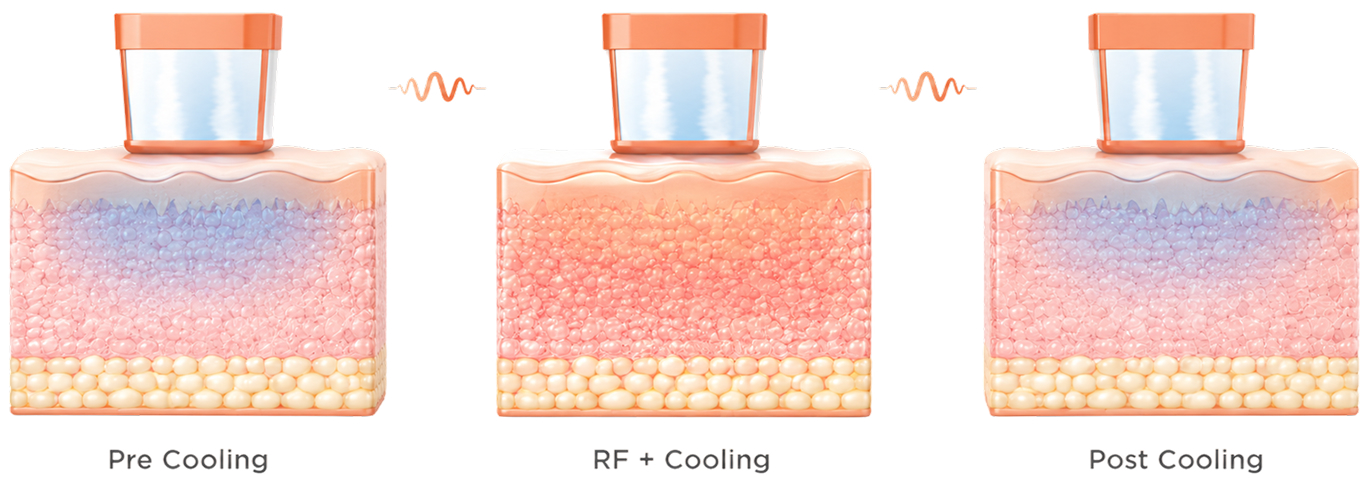 올리지오 쿨링 시스템 3단계 (Pre Cooling / RF + Cooling / Post Cooling)