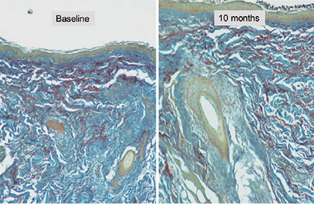 Comparison of elastin histology images — baseline and 10 months after treatment