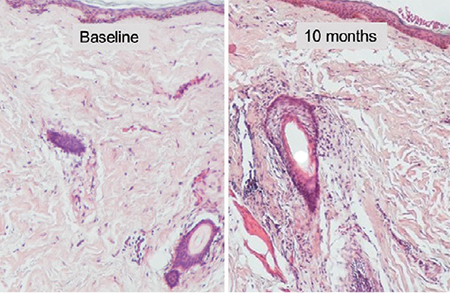 Comparison of collagen histology images — baseline and 10 months after treatment