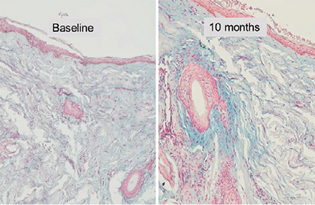 Comparison of hyaluronic acid histology images — baseline and 10 months after treatment