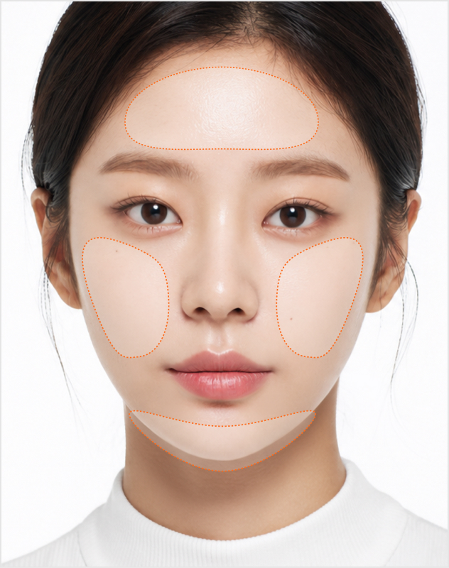 소프라노 티타늄 시술 부위